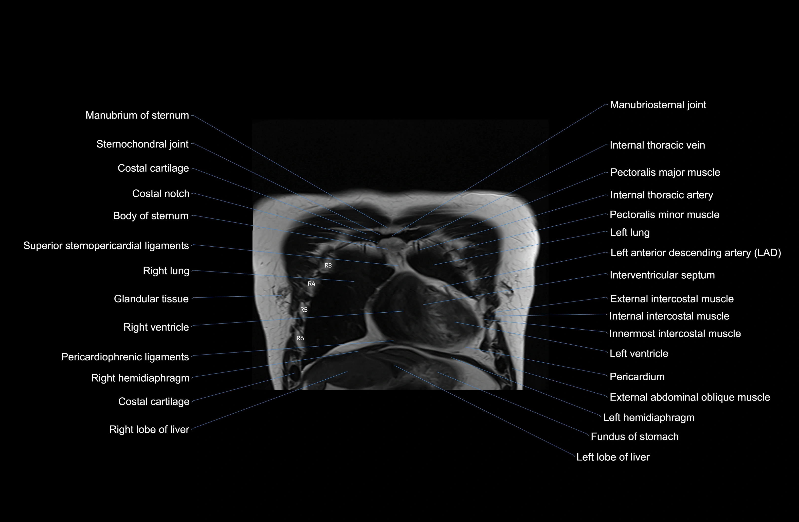 MRI chest (thorax) coronal  cross sectional anatomy 3T radiology  image-img-00001-00009.webp